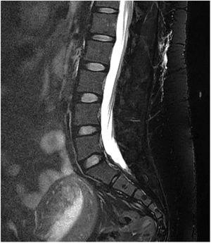 Cerebrospinal fluid collection in the lumbar soft tissues in a 34-year-old woman with postoperative spontaneous intracranial hypotension following antepartum spinal anaesthesia. Courtesy of Dr Belvís. Neurology department, Hospital de la Santa Creu i Sant Pau. Barcelona.