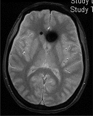 Subdural fluid collection (subdural haematoma) in the parieto-occipital convexity of a 46-year-old man with spontaneous intracranial hypotension following spinal anaesthesia administered for knee surgery. Courtesy of Dr. Belvís. Neurology department, Hospital de la Santa Creu i Sant Pau. Barcelona.