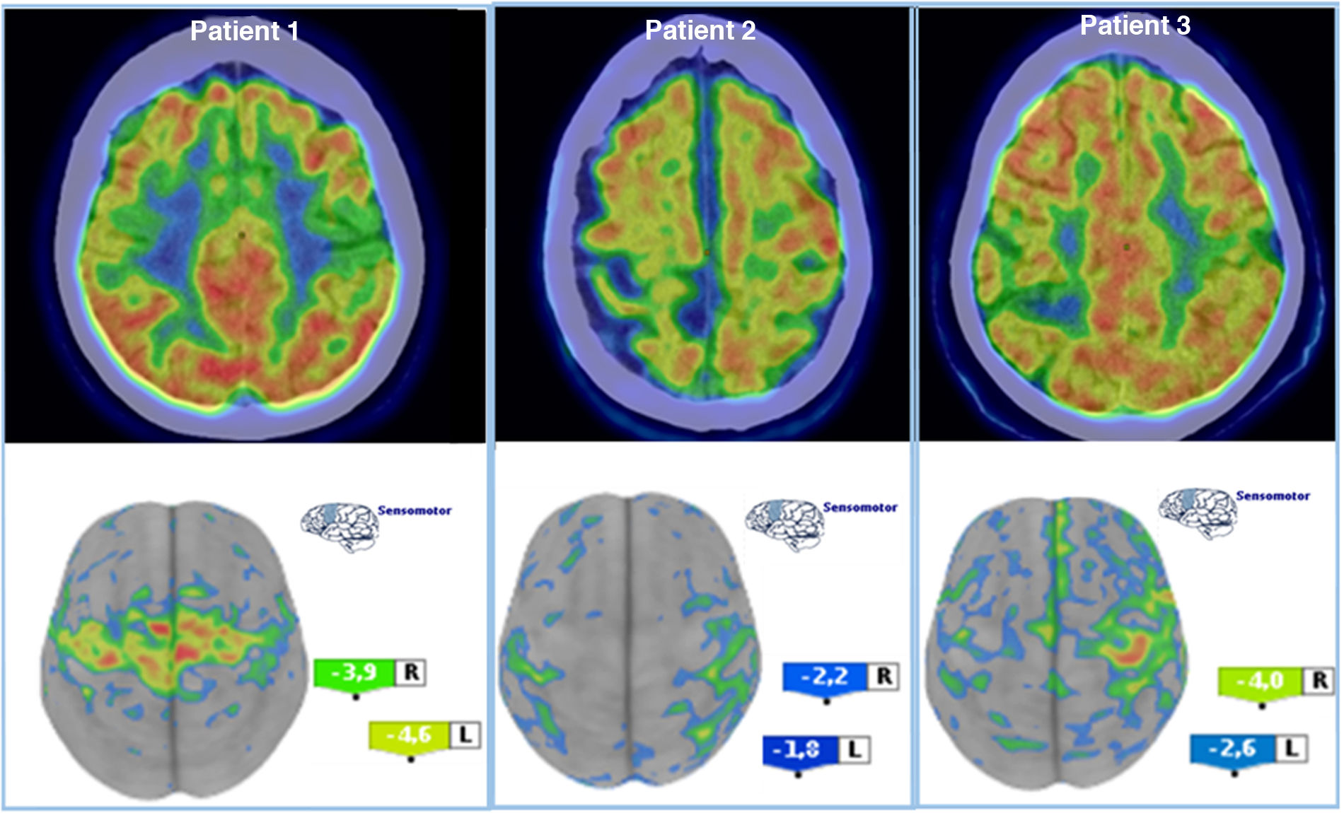 Motor band sign in 18F-FDG PET/CT studies: a biomarker of degenerative ...