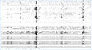 Surface EEG study showing the onset of a seizure with RINCH motions in a patient with tumoural structural epilepsy secondary to left parahippocampal cavernoma. The study was performed prior to lesionectomy. Top: monopolar montage with average reference. Bottom: longitudinal bipolar montage. Both traces show rhythmic theta activity in left temporal electrodes (F7, T7, P7). Low-frequency filter: 0.5 Hz, high-frequency filter: 70 Hz; notch filter: 50 Hz; sensitivity: 10 µV/mm, time base: 30 mm/s.