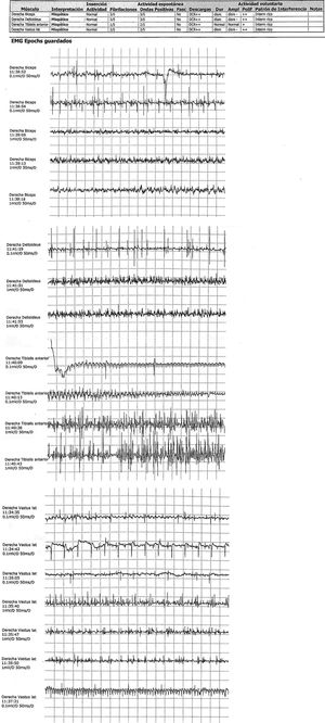 Electromyography recording showing predominantly proximal primary muscle involvement with high-intensity inflammatory signs.