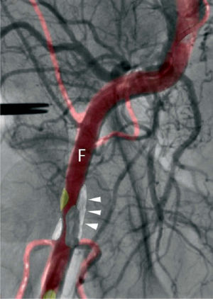 Fusion imaging with MSCT and angiography to guide vascular puncture at the beginning of the procedure. Calcified plaques can be seen (arrows) in the common femoral artery (F).