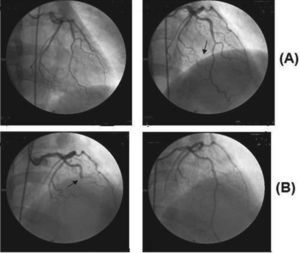 Coronary angiogram showing almost total occlusion of the second diagonal (A) and the descending anterior coronary artery (B).