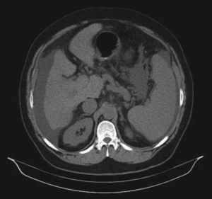 Abdominal computed tomography, showing highly heterogeneous texture of the liver and thrombosis of the portal and superior mesenteric veins (partially visualized in this image).