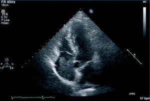 Two-dimensional echocardiography, showing a hyperechogenic structure measuring 5 × 3.2cm adhering to the lateral wall of the right atrium.