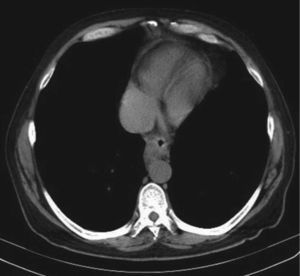 Thoracic computed tomography, showing a lesion suggestive of a thrombus in the right atrium, extending proximally to the vena cava (not visible in this image).