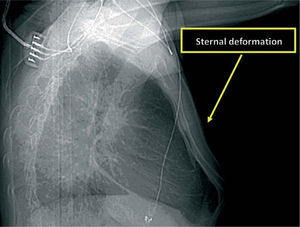 Chest X-ray, lateral view, showing detail of sternum morphology.