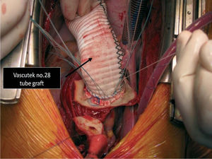Intraoperative image, showing replacement of the ascending aorta by a tube graft.