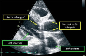 Transthoracic echocardiogram, five days after surgery, parasternal long-axis view, showing tube graft and aortic valve prosthesis.