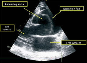 Transthoracic echocardiogram at admission, parasternal long-axis view, showing aneurysmal dilatation of the ascending aorta with visualization of the dissection flap.