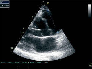 Transthoracic echocardiogram at admission, parasternal long-axis view, with measurement of aneurysmal dilatation.