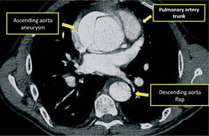 CT angiography, transverse plane at the level of the ascending aorta, showing dissection flap and aneurysmal dilatation.