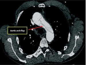 CT angiography, transverse plane at the level of the aortic arch, showing dissection flap.