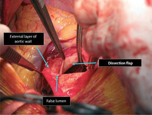 Intraoperative image: detail of the aortic wall, showing dissection flap, the false lumen and the outer layers of the aortic wall.