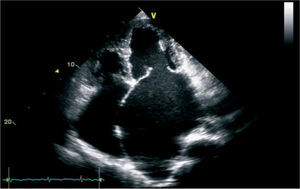 2D transthoracic echocardiogram in apical four-chamber view revealing massively dilated atria, giving a dwarfed appearance to the normal-sized ventricles.