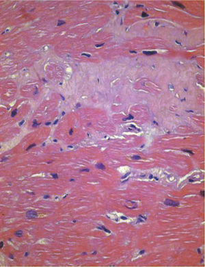 Endomyocardial biopsy from the right ventricle (hematoxylin-eosin stain) showing degeneration of myocardial fibers and interstitial fibrosis.