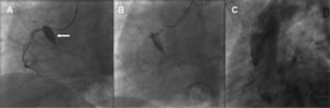 Coronary angiogram in left anterior oblique view clearly demonstrating contrast filling the false lumen of the aortic wall (A); stenting the RCA ostium (B); aortography showing contrast inside the aortic wall (C).