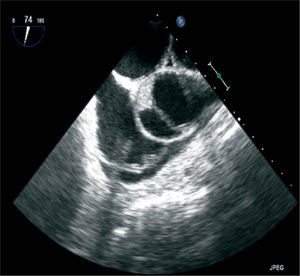Transesophageal echocardiography performed immediately after the complication, in modified short-axis view at the level of the aortic root, showing the aortic flap and the partially thrombosed lumen.