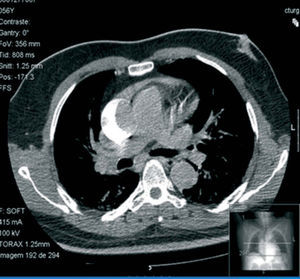 Chest CT scan showing the ascending aortic dissection with the contrast inside the false lumen in the posteroexternal wall of the aorta.