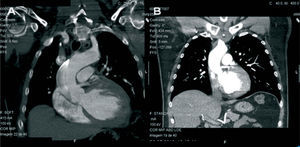 Chest CT scan immediately after percutaneous intervention showing the aortic dissection sparing the aortic arch and its main vessels (A); CT scan three months after discharge revealing complete reabsorption of the intramural hematoma (B).