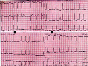 12-lead ECG at admission, showing atrial fibrillation, left ventricular hypertrophy and alterations suggestive of overload.