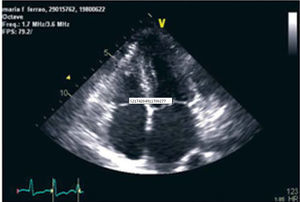 Two-dimensional echocardiography, apical 4-chamber view, showing left atrial dilatation and left ventricular hypertrophy.