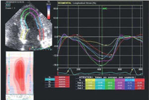 Longitudinal strain by two-dimensional speckle tracking: marked reduction of strain at the basal septum.