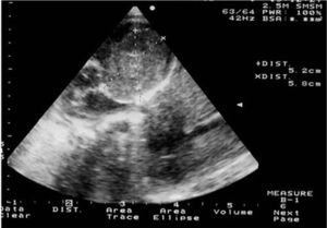 Transthoracic echocardiogram in 4-chamber view, showing a large heterogeneous mass in the left ventricle emerging from the free wall.