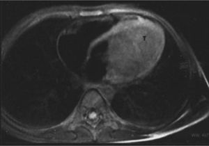 Cardiac magnetic resonance imaging, showing a large tumor (T), hyperdense and with a homogeneous signal, measuring 5.5×4.5cm, separate from the myocardium, emerging from the left ventricular free wall.
