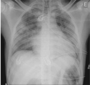 Anteroposterior chest X-ray in dorsal decubitus at 30º immediately after onset of acute pulmonary edema.