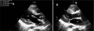 Transthoracic echocardiogram in parasternal long-axis view, in diastole (A) and systole (B), showing no left ventricular dilatation or hypertrophy, preserved systolic function and no structural valve disease. AE: left atrium; Ao: aorta; VD: right ventricle; VE: left ventricle.