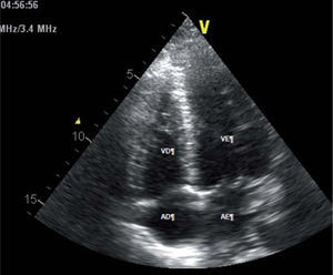 Transthoracic echocardiogram in 4-chamber apical view, showing no dilatation of the cardiac chambers. AD: right atrium; AE: left atrium; VD: right ventricle; VE: left ventricle.
