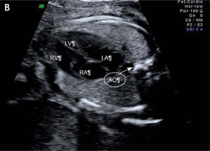 4-chamber view of the fetal heart. AO: aorta; LA: left atrium; LV: left ventricle; RA: right atrium; RV: right ventricle.