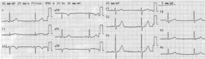 Admission 12-lead electrocardiogram, showing slight ST-segment elevation with downward concavity in II, III and aVF.