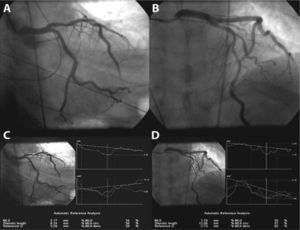 Invasive coronary angiography showing moderate stenosis of the proximal (A) and mid (B) anterior descending artery and its quantification (C and D).