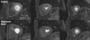First pass perfusion cardiac MRI in short-axis basal, mid and apical views, showing no perfusion defects with vasodilator stress or at rest.