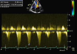 Peak gradient in the left ventricular outflow tract caused by systolic anterior motion.