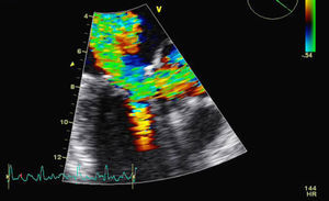 Transesophageal echocardiogram, with Doppler study of the left ventricular outflow tract.