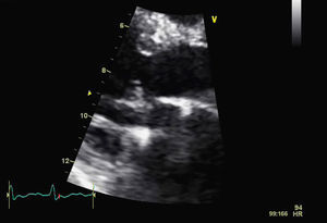Transthoracic echocardiogram in parasternal view, showing left ventricular outflow tract in systole after optimization of therapy, with no systolic anterior motion.