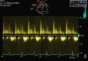 Transthoracic echocardiogram with continuous wave Doppler study of the left ventricular outflow tract, showing normalization of the left ventricular-aortic gradient.