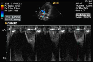 Aortic valve gradient estimated by pulsed wave Doppler after surgical correction.