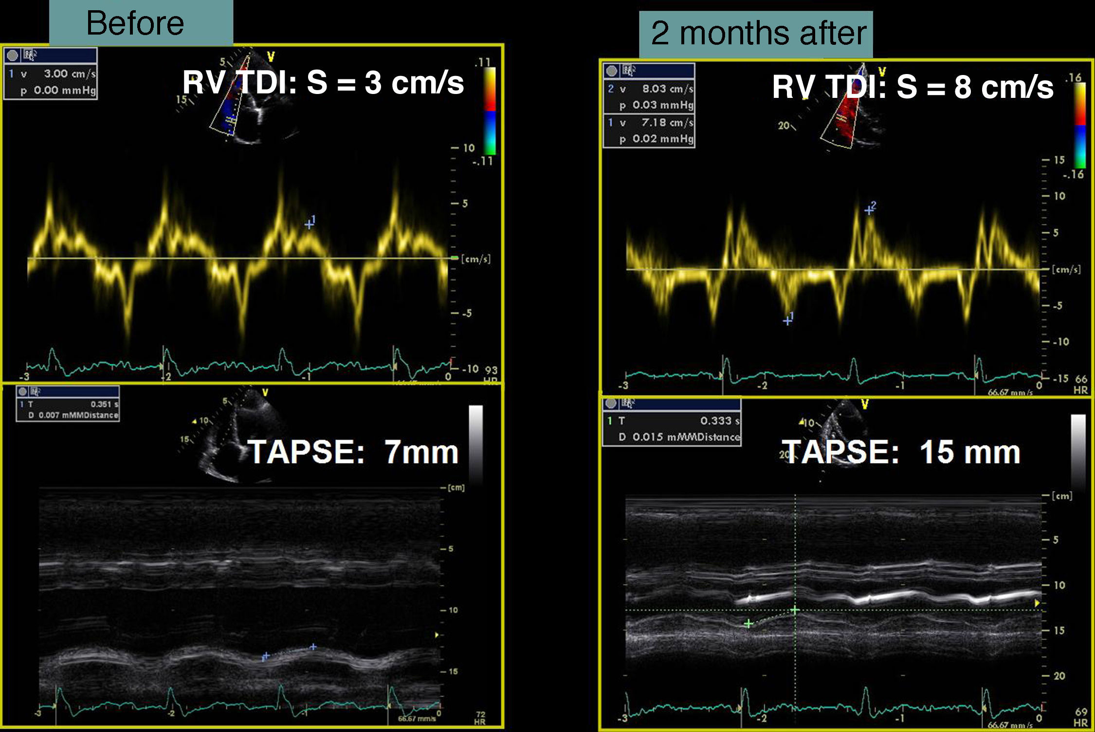 Successful cardiac resynchronization therapy in a patient with heart ...