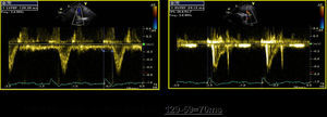 Interventricular dyssynchrony: difference of 70ms between pre-ejection of pulmonary (129ms) and aortic (59ms) flows, assessed by spectral Doppler.