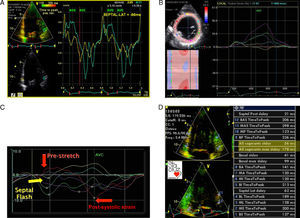 A TDI/TSI showing absence of intraventricular longitudinal dyssynchrony: difference of <65ms in peak systolic Q septal versus lateral inferior tissue velocity (56ms). (B and C) Early septal contraction (septal flash: early systolic curves) and peak lateral strain after aortic valve closure: difference of >130ms between post-systolic strain (late curves) and peak septal strain assessed by radial strain in parasternal view and longitudinal strain in apical 4-chamber view. The characteristic curves of radial and longitudinal strain seen in septal flash can be identified: early septal contraction (septal flash), early systolic pre-stretching (absence of contraction=stretching) of the lateral wall with peak strain after aortic valve closure (post-systolic strain). (D) Yu index: standard deviation of the 12 basal and mid segments (apical 4-chamber, apical 2-chamber and apical long-axis views) of >32ms.