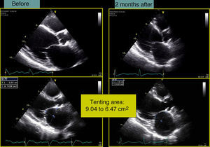 Tenting area before and after CRT-ICD implantation.