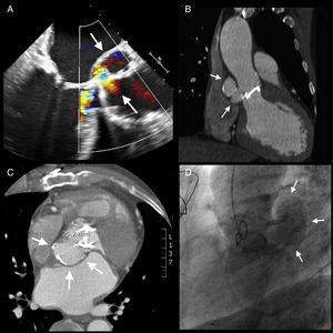 (A) Transesophageal echocardiography showing dehiscence of the prosthesis and blood flow between the aortic root and the cavity. (B and C) Multislice CT identifying the neck of the aneurysm. (D) Aortography showing severe AR and a large aneurysm posterior to the aortic root.