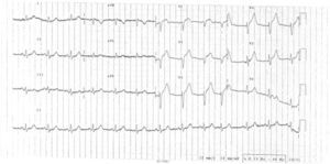 Admission ECG showing sinus rhythm, with Q waves in V1 and V2 and ST elevation in V1–V5.