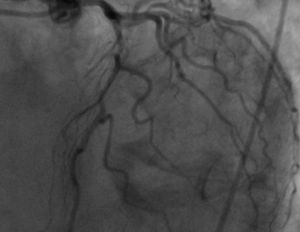 Coronary angiography showing subocclusive stenosis of the proximal segment of the left anterior descending artery.