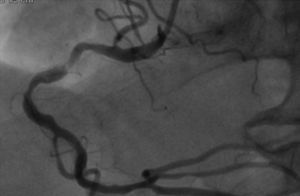 Coronary angiography showing subocclusive stenosis of the proximal segment of the right coronary artery.
