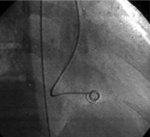 Closure of coronary fistula with a controlled-release Jackson coil and three standard coils.